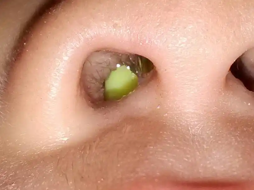 请问小孩的一边鼻孔里有苹果颜色的物体的东西是什么原因,看起来好像