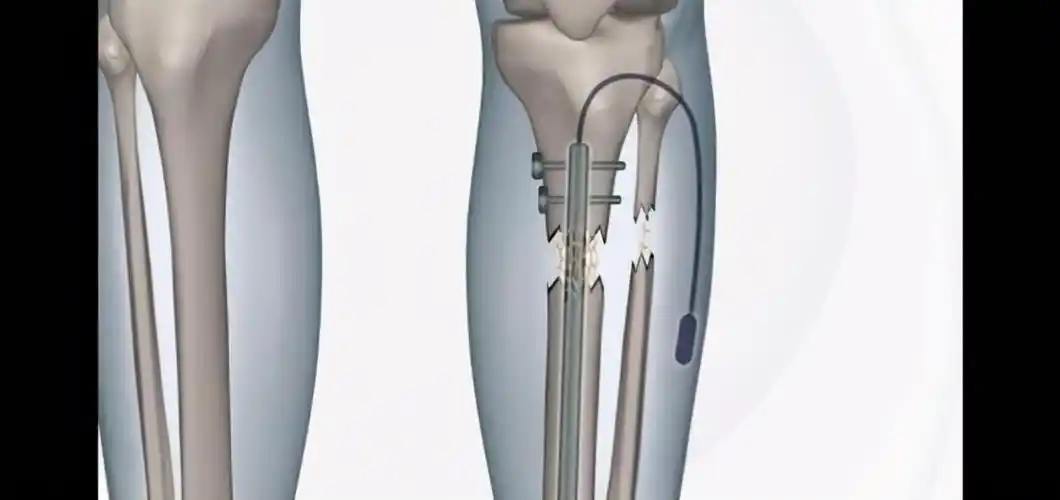 李亚诺决定在16岁的生日当天来进行断骨增高手术,在医美整形医院,医生