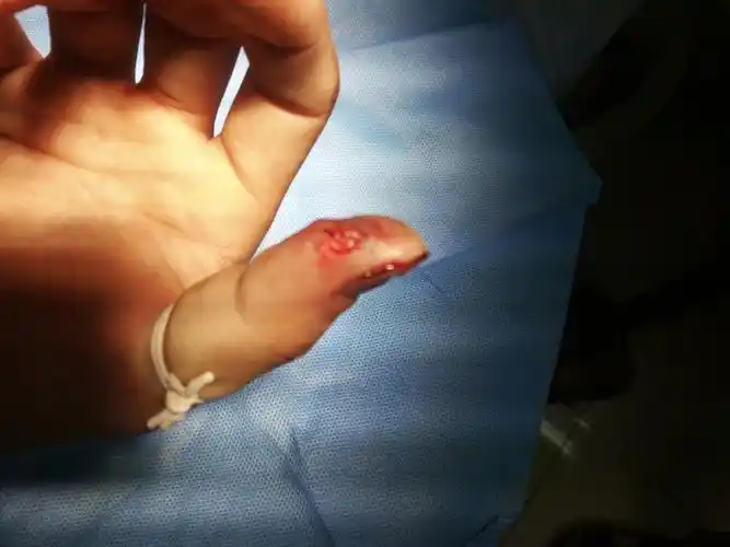 在工厂出工伤,右手大拇指尖粉碎性骨折,问医生说能评十级伤残,具体能