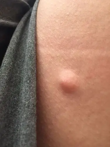 这是脂肪瘤吗?好多年了,坐着咯到还有点酸