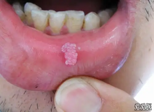 唇粘膜尖锐湿疣病例讨论研究