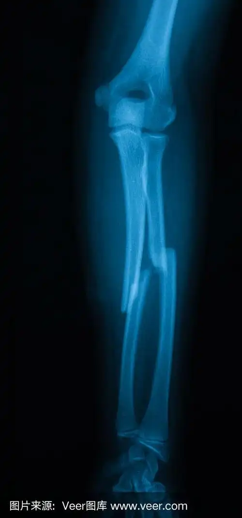 前臂,尺骨,桡骨骨折x线照片.