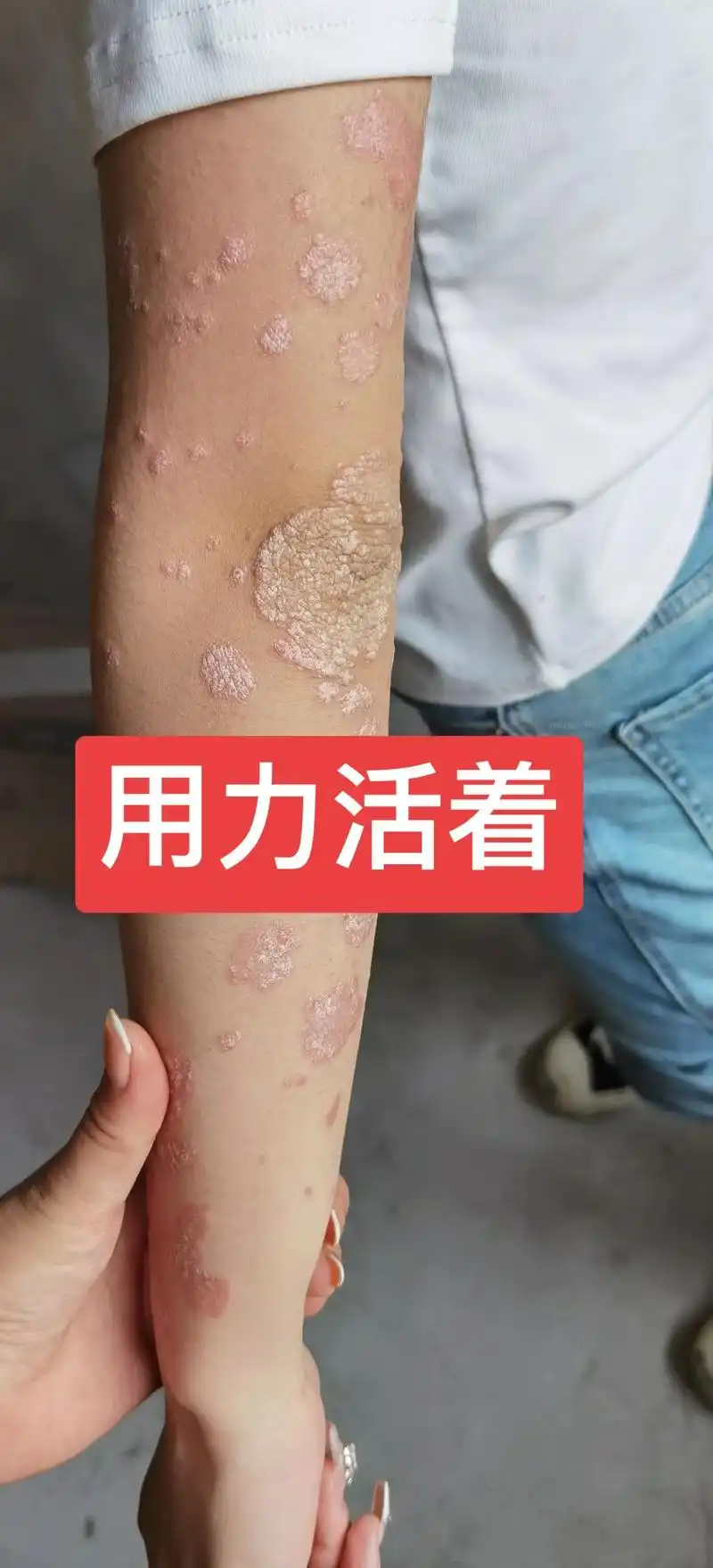 牛皮癣 #有一种痒看到都痒 - 抖音