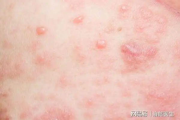 得了糖尿病这些皮肤问题请多重视或有助降糖控糖