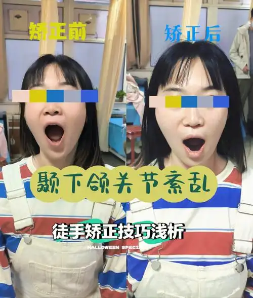 颞下颌关节紊乱  #颞下颌关节脱位  #手法  #面部徒手矫正进行颞下颌