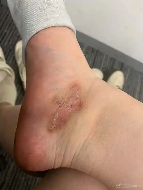 神经性皮炎合并湿疹