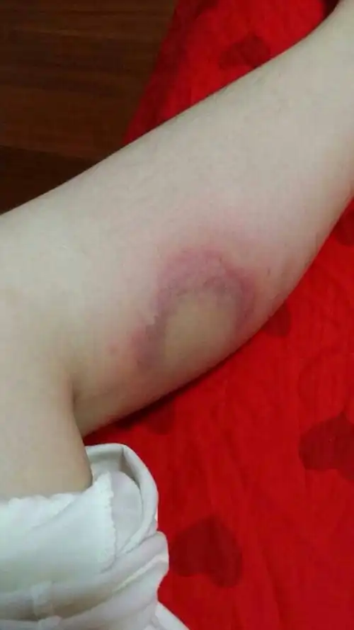 2014-04-04 陈闯 医师 皮肤被蚊子咬肿化脓吃头孢可以吗还是罗红霉素?