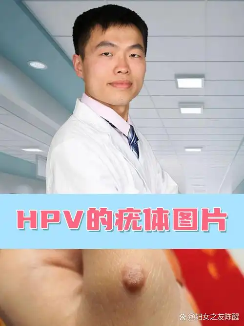 hpv的疣体图片  hpv疣体是由特定类型的人乳头瘤病毒感染引起的皮肤