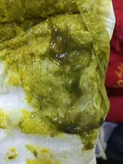 肠炎大便图片结肠炎大便不成形2022已更新今日图集