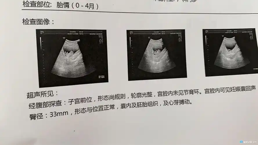 [试管婴儿]孕10周,宝宝成型,手脚都看得