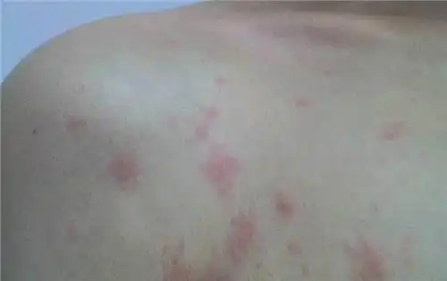 乙肝蜘蛛痣早期图片 (40)