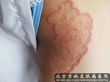 大腿内侧长癣大腿肚内侧有红点可能与两种疾病有关,比如湿疹或者股癣