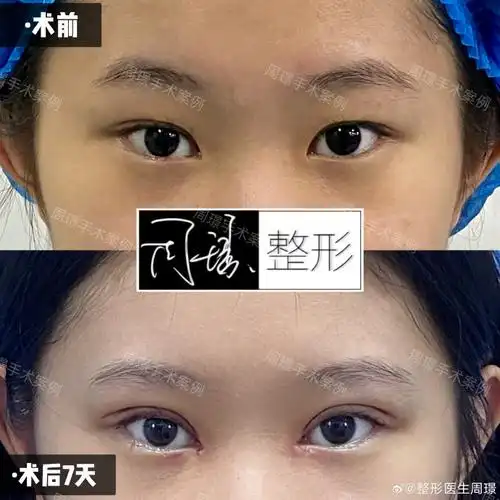 埋线双眼皮修复##开眼角##眼修复##厦门眼修复