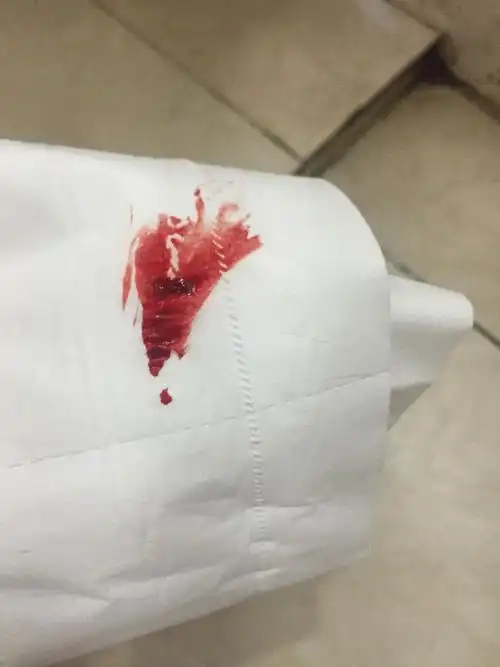 大便出血了,不疼不痛,经常通宵熬夜,本人没有痔疮
