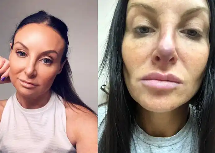 美国女子整容失败鼻子变形用水蛭治疗竟然恢复