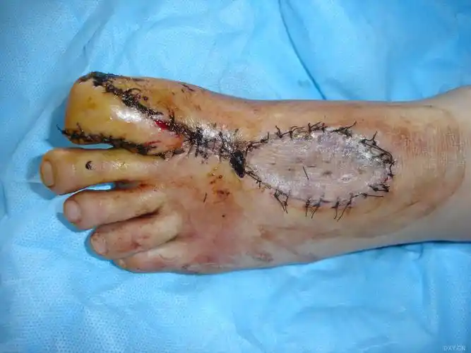 足背逆行皮瓣修复足拇指皮肤缺损