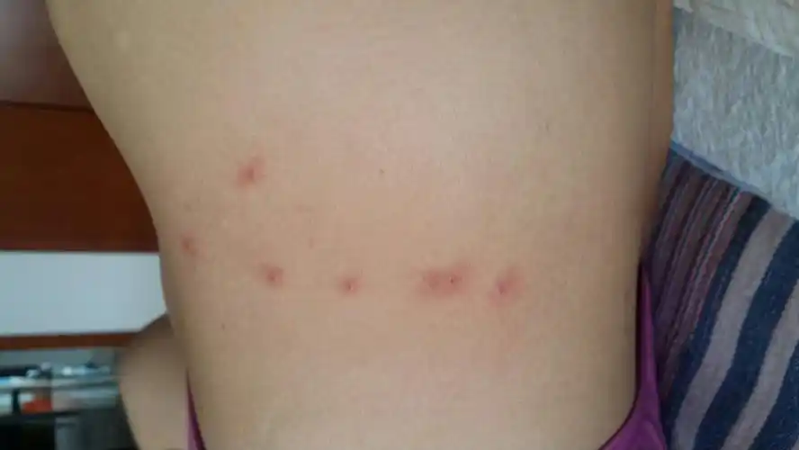 不知道被什么虫子咬了又红又痒,三个疙瘩成片连起来,楼主一直很注意