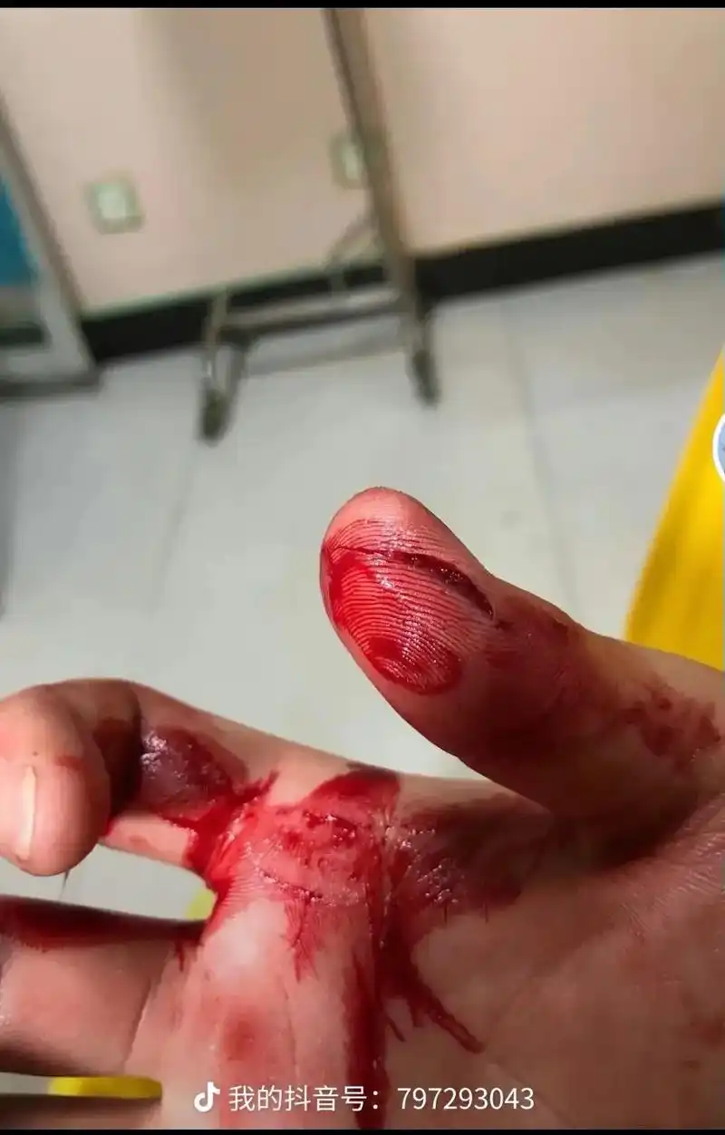 意外受伤 #流血不流泪 #伤口缝针有多疼 #为什么受伤的总 - 抖音