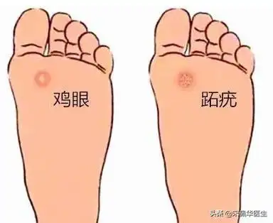 又把跖疣当成鸡眼了?这5招教您如何辨别