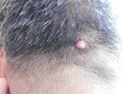 一亲戚头的后面长了一个很小的瘤,不痛不痒,要紧吗?