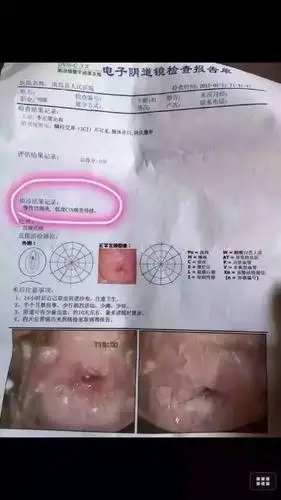 怎么才能彻底治愈hpv58