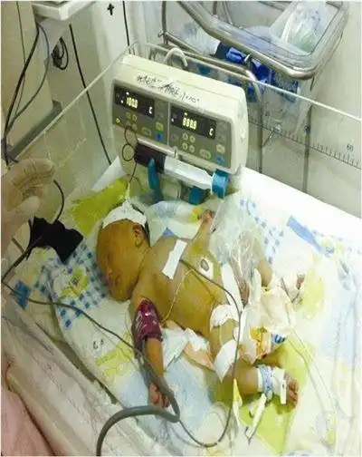 重症溶血症患儿需通过换血术缓解病情.