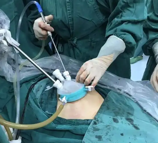 是手术更是艺术成都安琪儿首例宫外孕单孔腹腔镜手术获成功手术开创