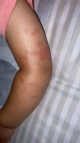 一个月前去了躺海边,回来孩子身上就出了丘疹,说是沙土皮炎,但是这