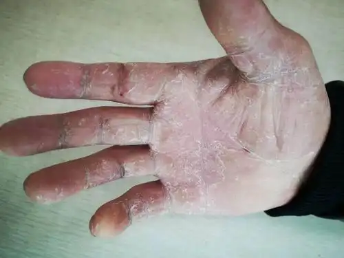 皮肤科医生告诉你真相_手癣