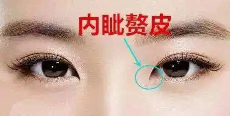 内眦赘皮应该怎么治疗呢