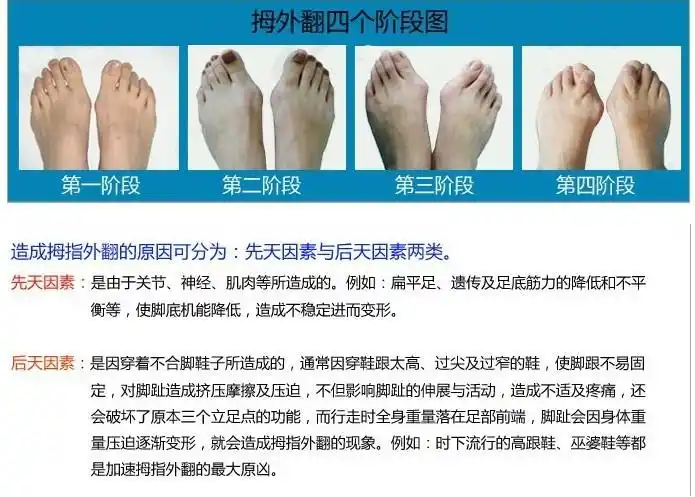 拇外翻矫正套大小脚趾外翻矫正器医 用硅胶套姆指分趾垫