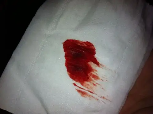 有喷血,就肛门感觉一打开就有血流下来了.