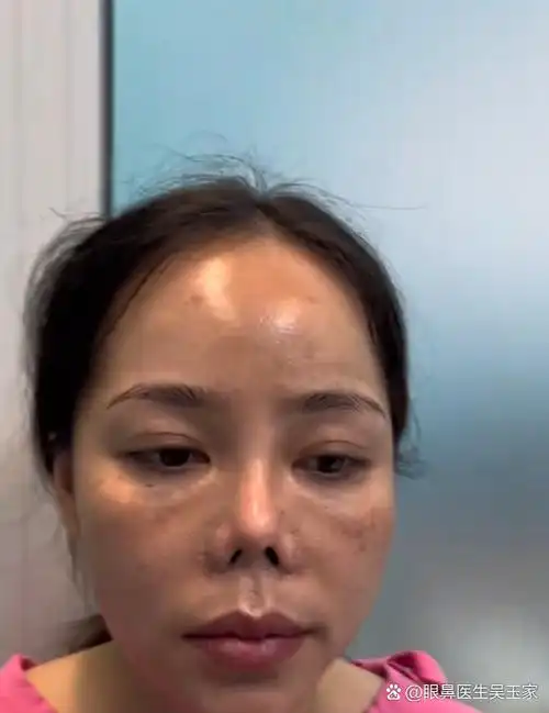 隆鼻手术失败导致鼻子挛缩,鼻体明显缩短,使得整个鼻子看起来十分怪异