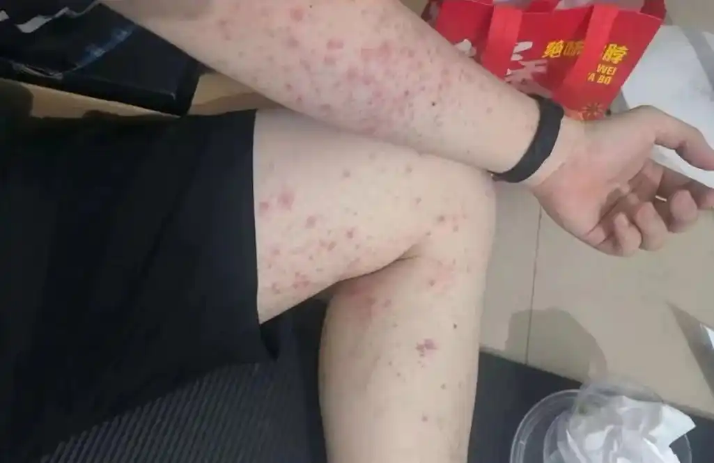 螨虫滋生让皮肤发炎长痘 #皮肤问题 #全身过敏 #日常护理  - 抖音