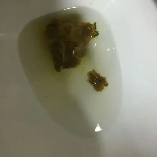 最近一个月排便比较稀 有时候稀稀的小小块的 有时侯胃会有点不舒服