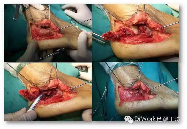 跟骨钢板|足踝圆桌002