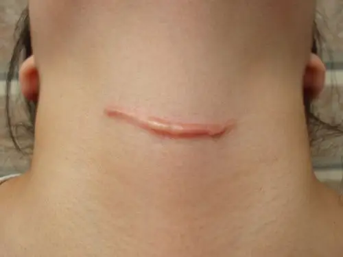 伤口深手术后增生性疤痕图片