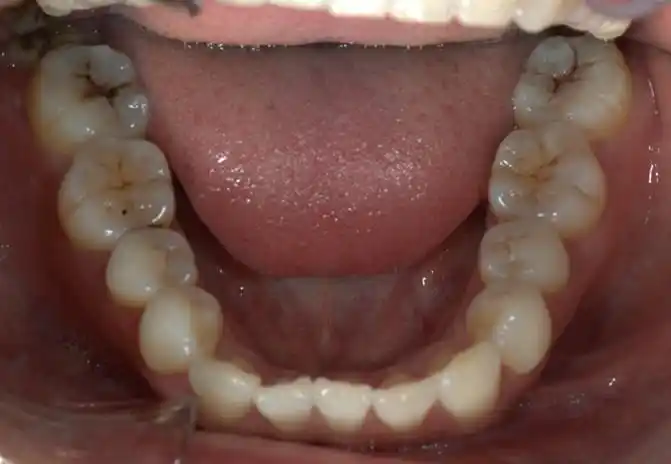 下牙列牙颌面照片