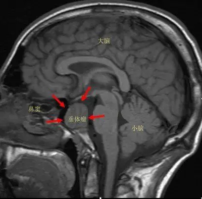 揭开垂体瘤神秘的面纱 - 好大夫在线