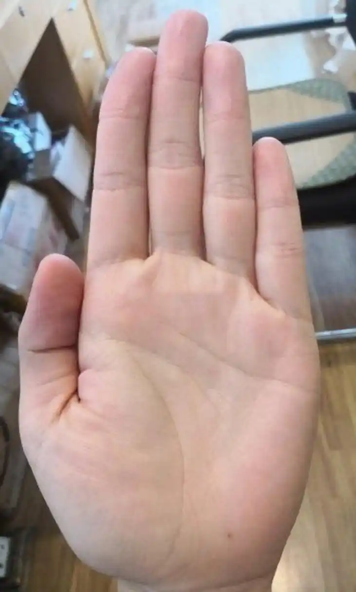 手相看月丘上有痣,你是一个比较感性的人,热爱自由,追求浪漫和文艺