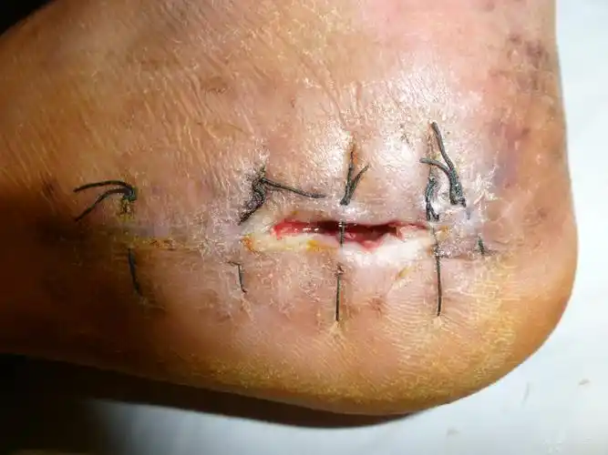 请支招:跟骨骨折术后皮瓣愈合不良. [病例帖]