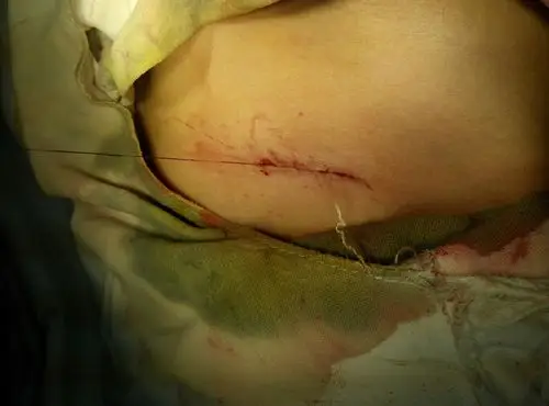 白线疝形成原因图