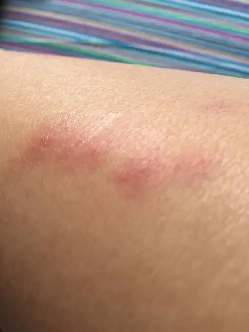 这是被什么虫咬的?该怎么办