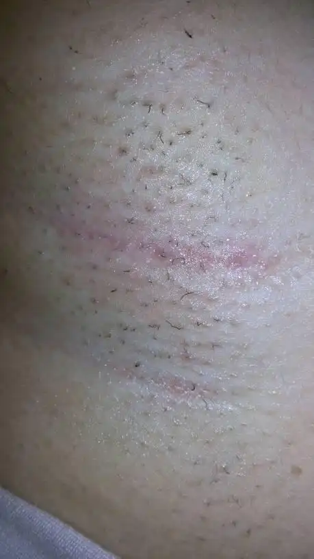 腋下用过脱毛膏之后很痛而且很红怎么办?