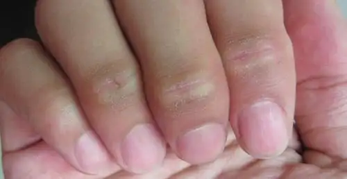 50分悬赏 我的手指关节处的皮,如图,变硬,皮变厚,蜕皮,龟裂,出血,怎么