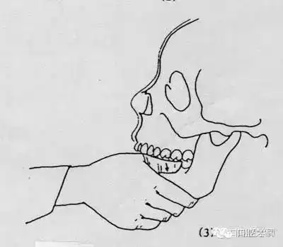 问题探讨及处理 颞下颌关节脱位,妙招123你必须要知道 手法复位的操作