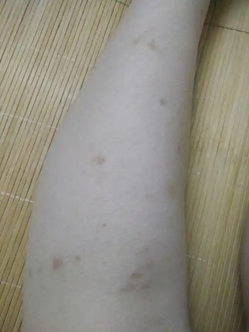 湿疹出现局部瘙痒,抓挠或继发炎症后,可以出现局部 色素沉着,可以外