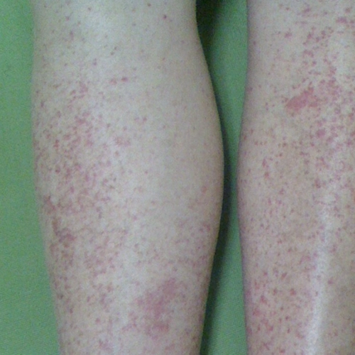 轻微紫癜的症状图片6