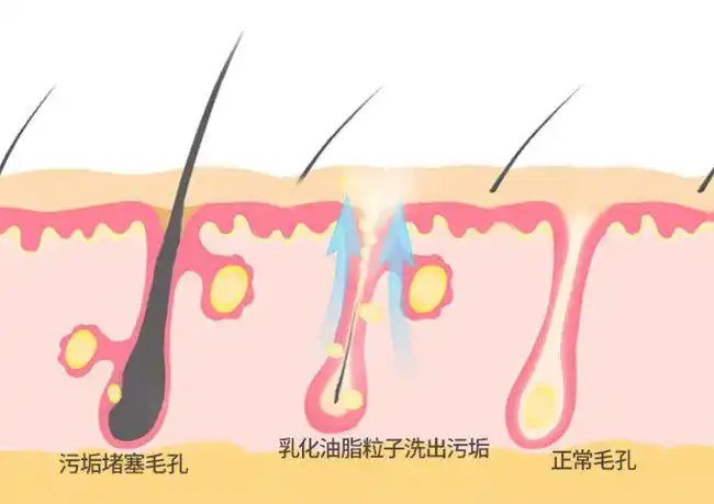 正常,粗厚角质堆积在毛孔周围,就会让毛孔变得粗糙,一起也简单被阻塞