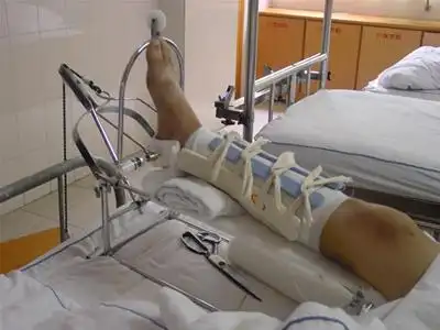 骨折的正确急救措施